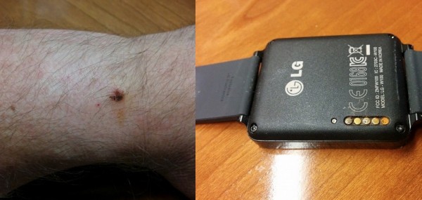 LG G Watch: Ladekontakte korrodieren, keine Garantieleistung?